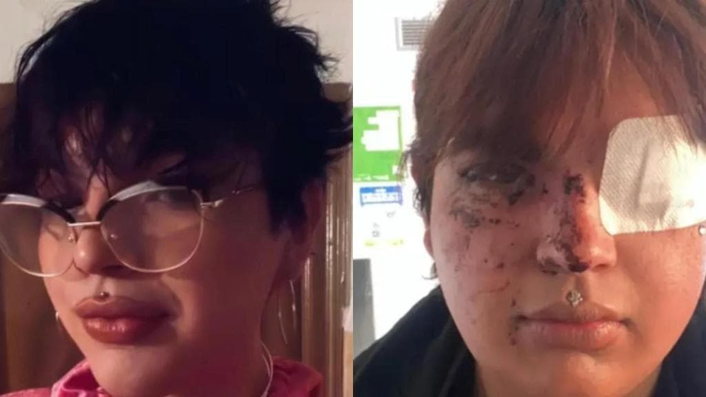 La barbarie en La Bañeza: paliza a Miss Trans Zamora que casi pierde un ojo